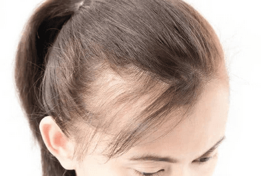 Causes of Women’s Hair Loss