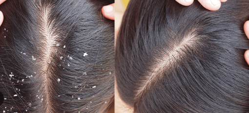 remove dandruff in one day