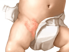 Side Effects Of Diapers
