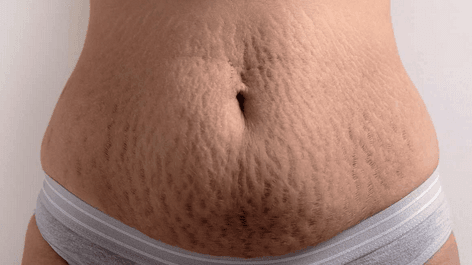 Stretch Marks
