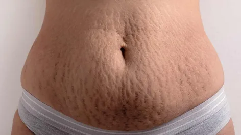 How to Get Rid of Stretch Marks After Pregnancy